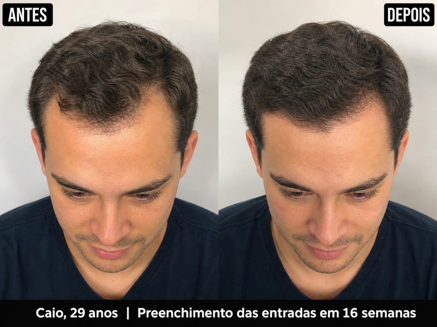 Antes e depois — Entradas — Caio Blasius