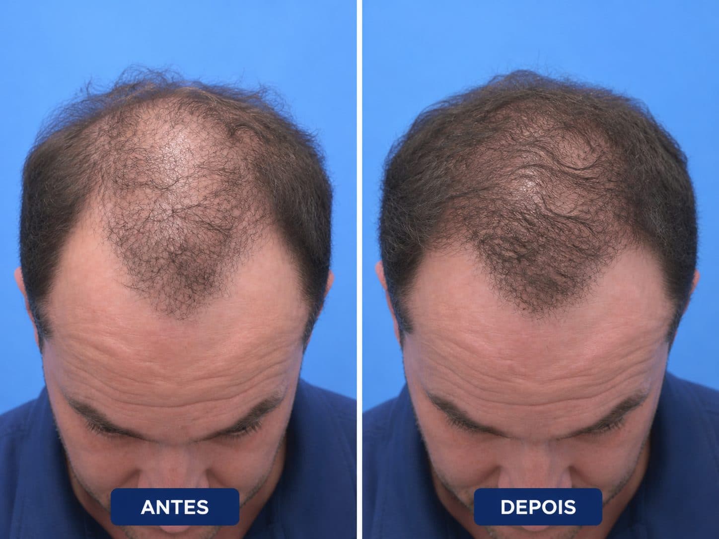 Antes e depois — Linha Frontal — Rafael Almeida